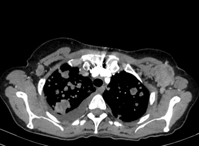 File:Cannonball metastases from breast cancer (Radiopaedia 91024-108569 A 29).jpg