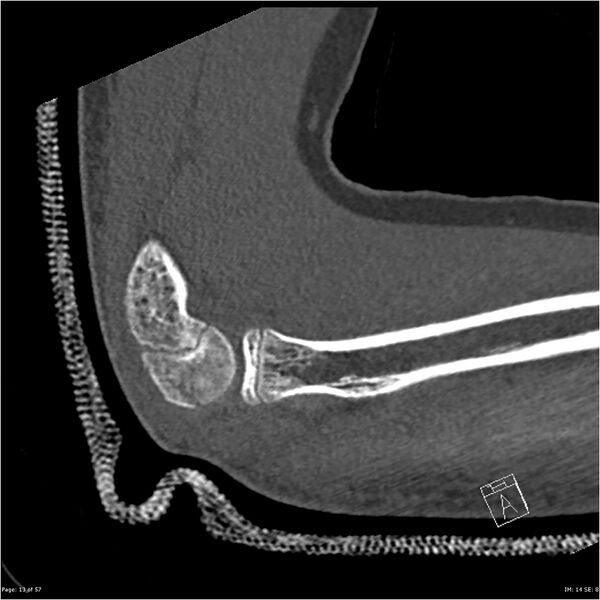 File:Capitellum fracture (Radiopaedia 23352-23426 Sagittal bone window 13).jpg