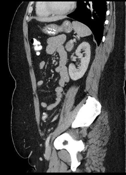 File:Carcinoid tumor - terminal ileum (Radiopaedia 60931-68739 C 28).jpg