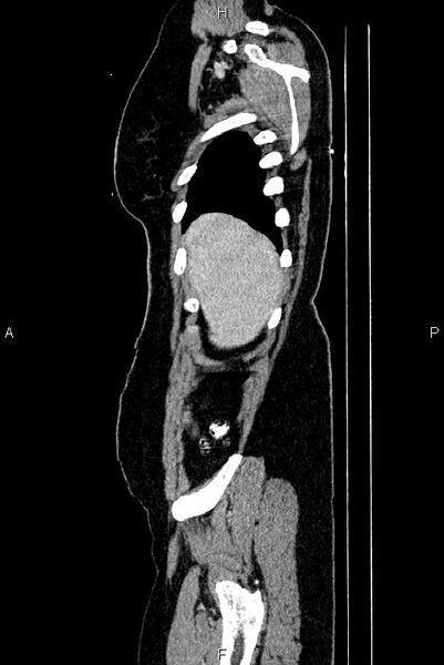 File:Carcinoma of uterine cervix (Radiopaedia 85861-101700 D 4).jpg