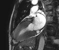 Cardiac amyloidosis (Radiopaedia 39736-42124 B 9).jpg
