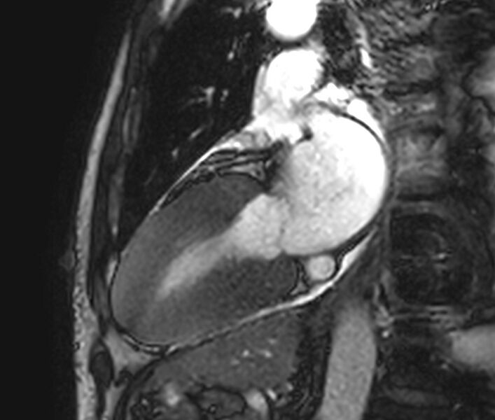 File:Cardiac amyloidosis (Radiopaedia 39736-42124 B 9).jpg