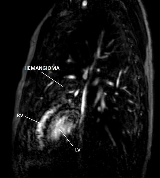 File:Cardiac hemangioma (Radiopaedia 16971-64065 Multiplanar 9).jpg