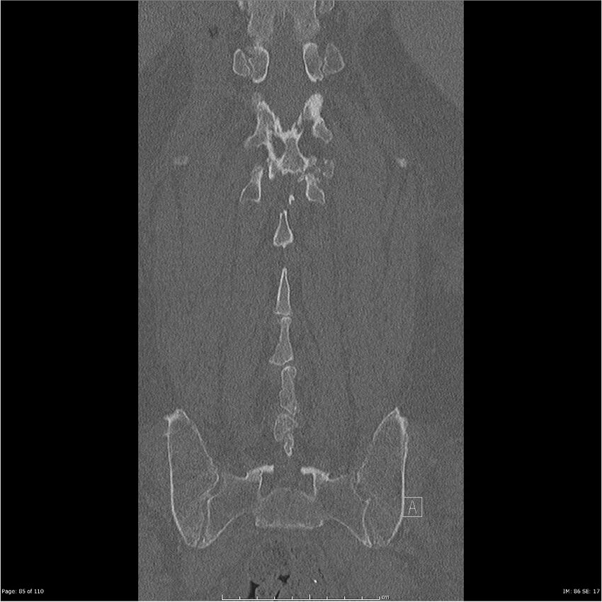 Cardiac trauma (Radiopaedia 32874-33858 Coronal bone window 85).jpg