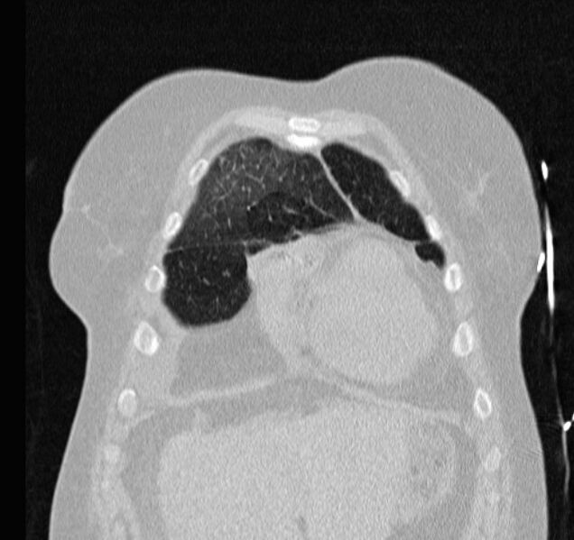 File:Cardiogenic pulmonary edema (Radiopaedia 29213-29609 Coronal lung window 10).jpg