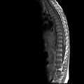 Caudal regression syndrome (Radiopaedia 61990-70072 Sagittal T1 7).jpg