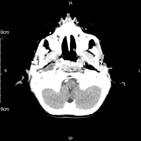 File:Cavernous sinus thrombosis (Radiopaedia 79414-92510 Axial Brain 50).jpg