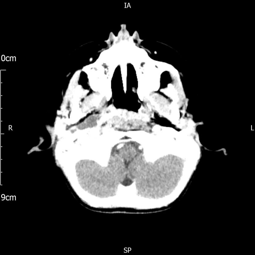 Cavernous sinus thrombosis (Radiopaedia 79414-92510 Axial Brain 50).jpg