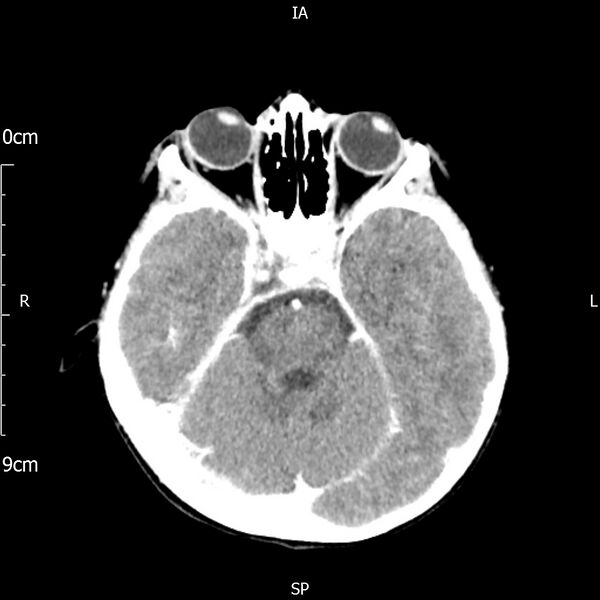 File:Cavernous sinus thrombosis (Radiopaedia 79414-92510 Axial Brain 78).jpg