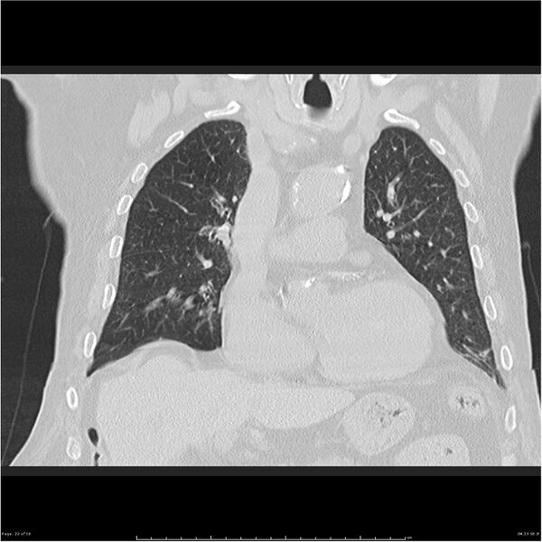 File:Cavitating left lower lobe lesion - squamous cell lung cancer (Radiopaedia 27749-28176 Coronal lung window 22).jpg
