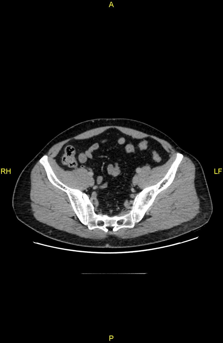 Cecal epiploic appendagitis (Radiopaedia 86047-102164 A 123).jpg