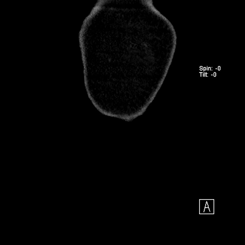 Cecal volvulus (Radiopaedia 90897-108397 Coronal non-contrast 60).jpg