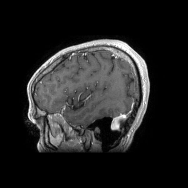 File:Central neurocytoma (Radiopaedia 67618-77021 Sagittal T1 C+ 24).jpg