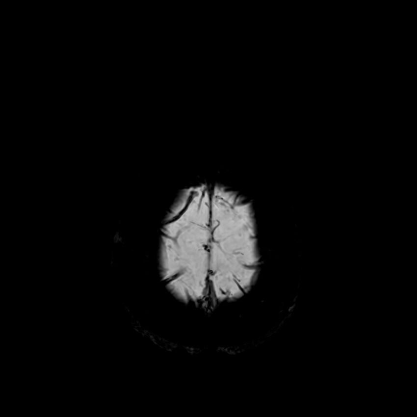 Central neurocytoma (Radiopaedia 79320-92380 Axial SWI 131).jpg
