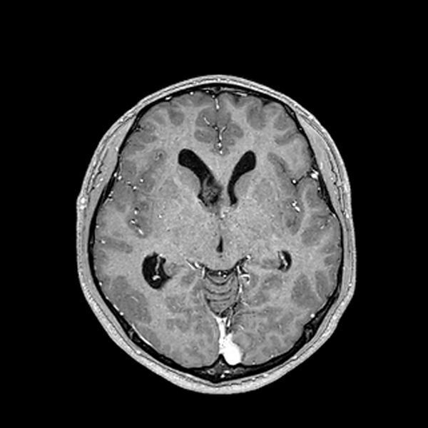 File:Central neurocytoma (Radiopaedia 79320-92380 Axial T1 C+ 117).jpg