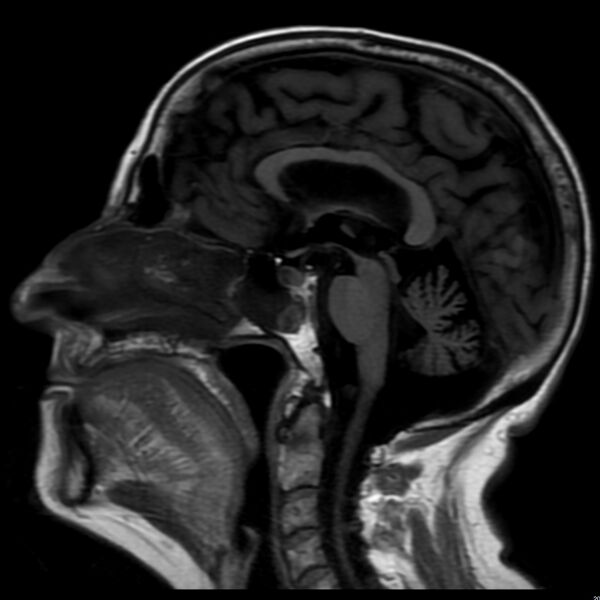 File:Cerebellar ataxia with neuropathy and vestibular areflexia syndrome (CANVAS) (Radiopaedia 74283-85159 Sagittal FLAIR 11).jpg