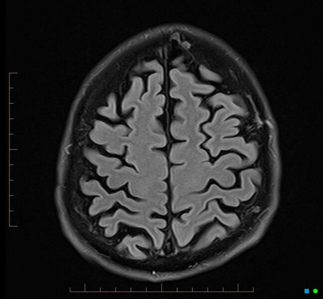 File:Cerebellar gangliocytoma (Radiopaedia 65377-74422 Axial FLAIR 32).jpg