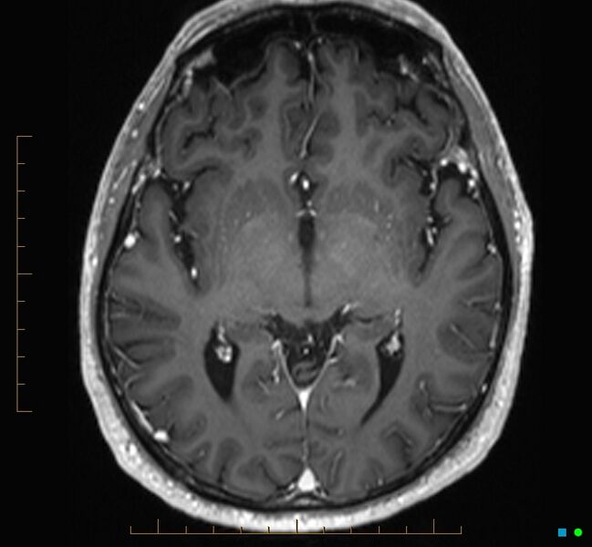 File:Cerebellar gangliocytoma (Radiopaedia 65377-74422 Axial T1 C+ 60).jpg