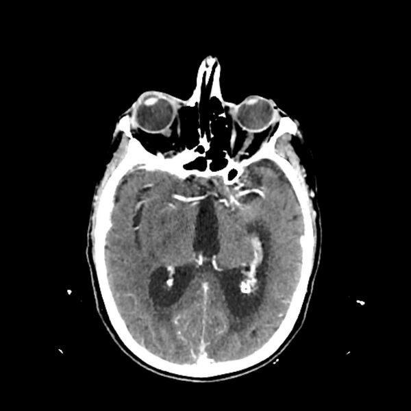 File:Cerebellar metastasis - lung tumor (Radiopaedia 69317-79145 Axial with contrast 20).jpg