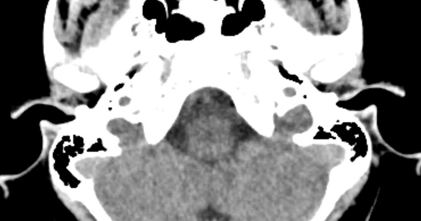 Cerebellopontine angle lipoma (Radiopaedia 57303-64242 B 15).jpg