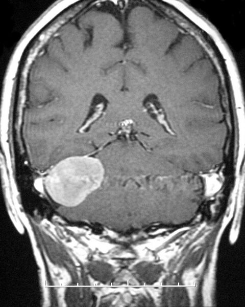 File:Cerebellopontine angle meningioma (Radiopaedia 2597-6293 Coronal T1 C+ 1).jpg
