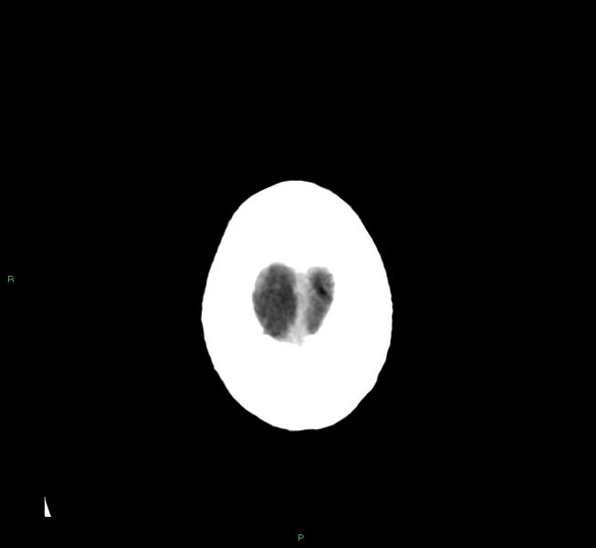 File:Cerebral amyloid angiopathy-associated lobar intracerebral hemorrhage (Radiopaedia 58376-65511 Axial non-contrast 6).jpg