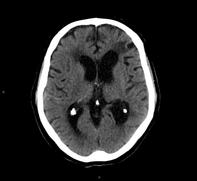 File:Cerebral amyloid angiopathy-associated lobar intracerebral hemorrhage (Radiopaedia 58376-65513 Axial non-contrast 27).jpg