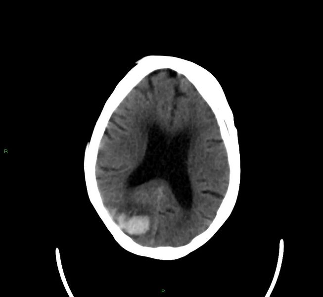 File:Cerebral amyloid angiopathy-associated lobar intracerebral hemorrhage (Radiopaedia 58377-65514 Axial non-contrast 21).jpg