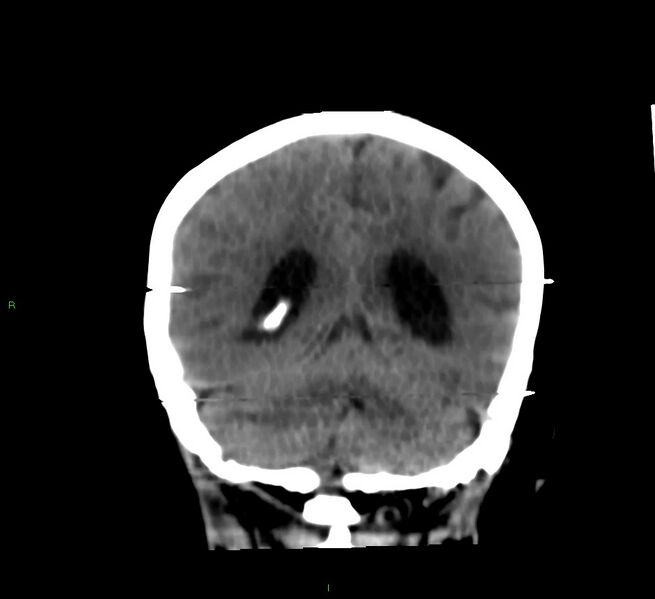 File:Cerebral amyloid angiopathy-associated lobar intracerebral hemorrhage (Radiopaedia 58377-65514 Coronal non-contrast 22).jpg