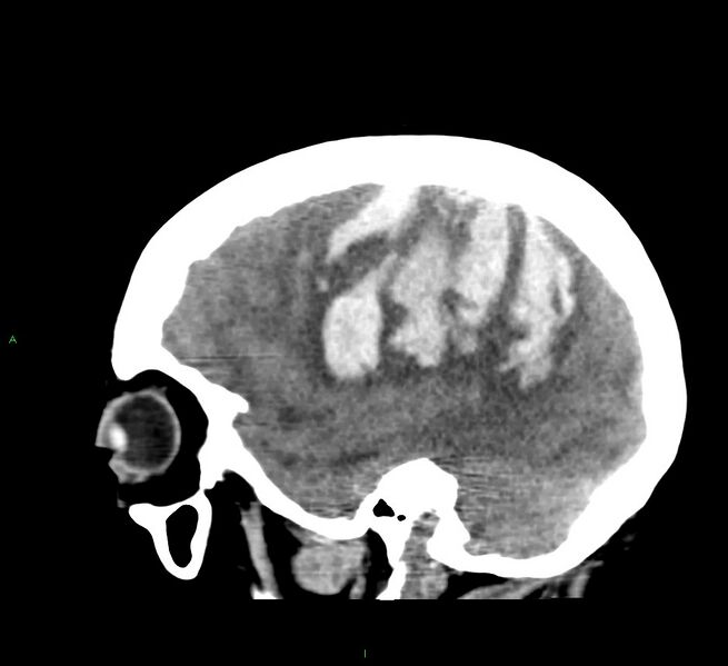 File:Cerebral amyloid angiopathy-associated lobar intracerebral hemorrhage (Radiopaedia 58379-65519 C 15).jpg