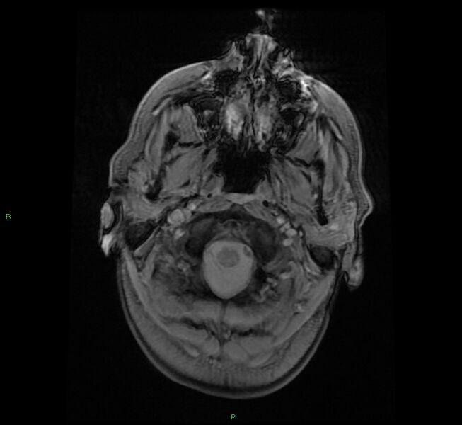 File:Cerebral amyloid angiopathy-associated lobar intracerebral hemorrhage (Radiopaedia 58529-65684 Axial Gradient Echo 2).jpg