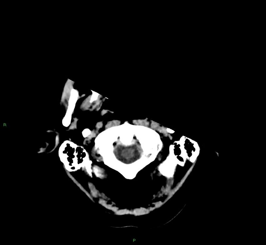 Cerebral amyloid angiopathy-associated lobar intracerebral hemorrhage (Radiopaedia 58530-65688 Axial non-contrast 48).jpg