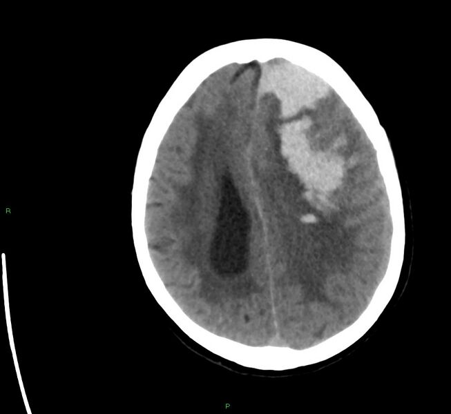 File:Cerebral amyloid angiopathy-associated lobar intracerebral hemorrhage (Radiopaedia 58561-65724 Axial non-contrast 16).jpg