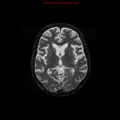 Cerebral and orbital tuberculomas (Radiopaedia 13308-13311 Axial T2 11).jpg