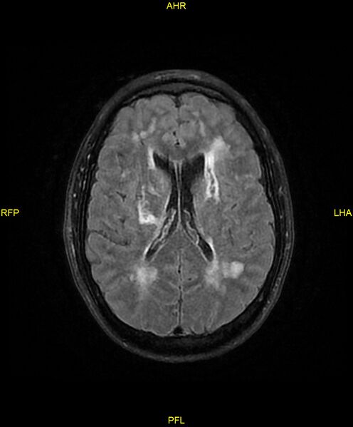 File:Cerebral autosomal dominant arteriopathy with subcortical infarcts and leukoencephalopathy (CADASIL) (Radiopaedia 86108-102054 Axial FLAIR 18).jpg