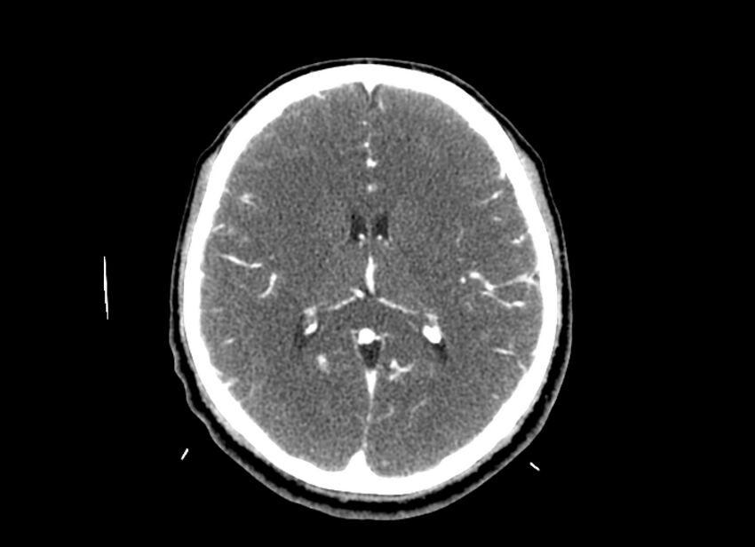 Cerebral edema (Radiopaedia 82519-96661 B 27).jpg