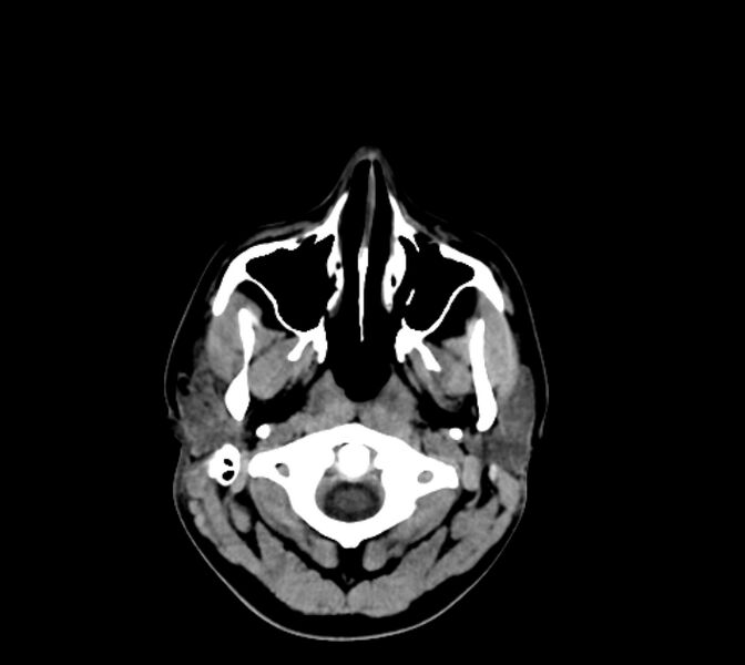 File:Cerebral fat embolism (Radiopaedia 37510-39362 Axial non-contrast 3).jpg
