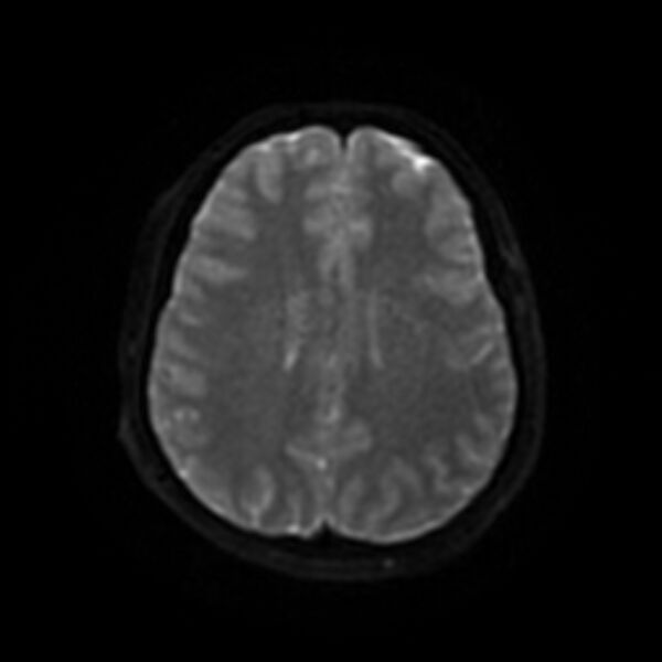 File:Cerebral fat embolism (Radiopaedia 37510-39363 Axial DWI 41).jpg