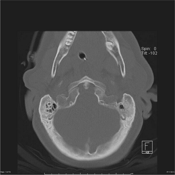 File:Cerebral hemorrhagic contusions and cervical spine fractures (Radiopaedia 32865-33841 C 5).jpg