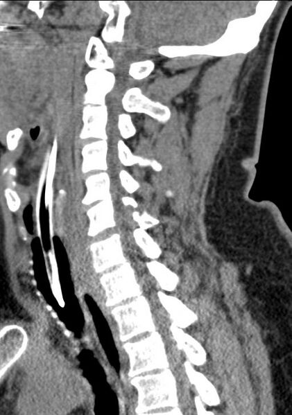 File:Cerebral hemorrhagic contusions and cervical spine fractures (Radiopaedia 32865-33841 G 53).jpg