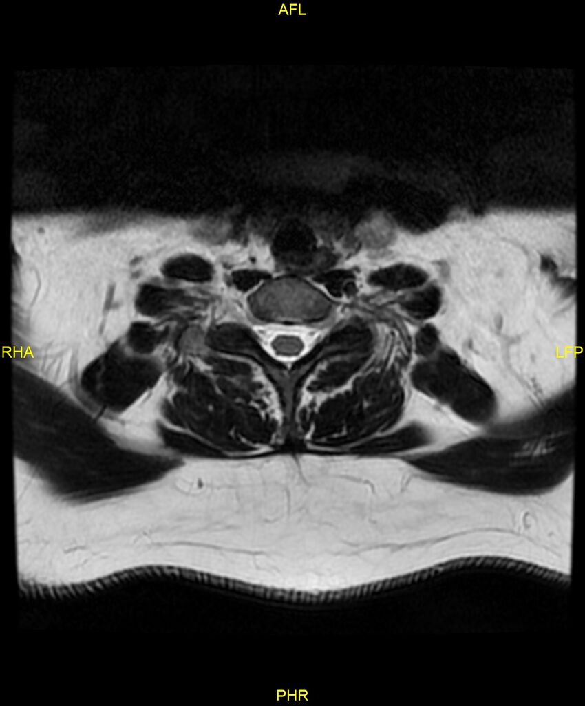Cervical disc protrusion (Radiopaedia 87147-103415 Axial T2 62).jpg