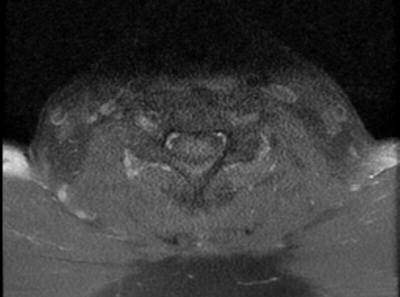 File:Cervical schwannoma (Radiopaedia 72399-82934 Axial T1 C+ fat sat 16).jpg