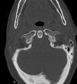 Cervical spine ACDF loosening (Radiopaedia 48998-54070 Axial bone window 13).png