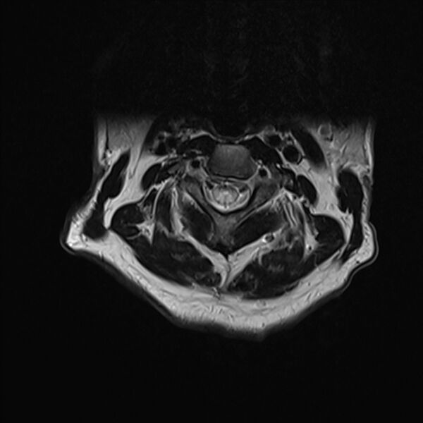 File:Cervical tumor-like myelopathy due to Type V dAVF (Radiopaedia 82461-96604 Axial T2 10).jpg