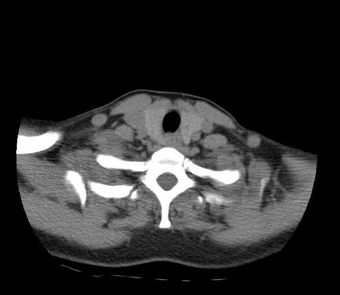 File:Cervical venous malformation (Radiopaedia 22653-22672 Axial non-contrast 45).jpg