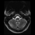 Cervical vertebrae metastasis (Radiopaedia 78814-91667 Axial T2 30).png