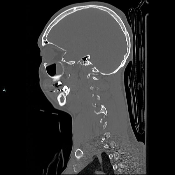 File:Cervical vertebral burst fracture (Radiopaedia 37420-39258 Sagittal bone window 2).jpg