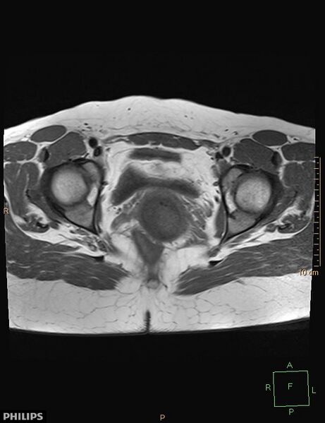 File:Cesarian scar endometriosis (Radiopaedia 68495-78066 Axial T1 18).jpg