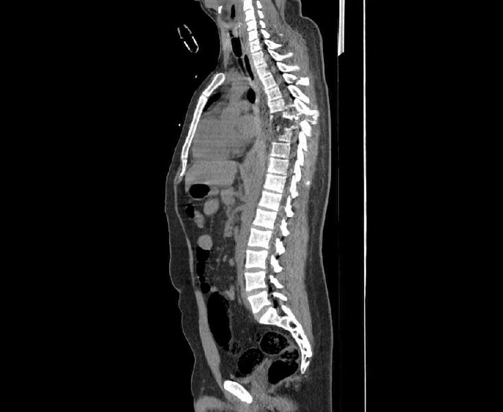 File:Chance fracture (Radiopaedia 38398-40475 Sagittal bone window 3).jpeg