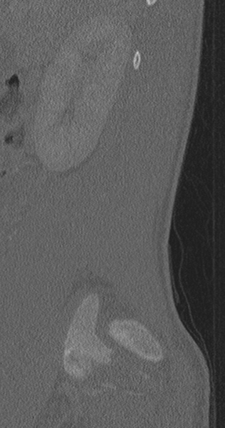 File:Chance fracture (Radiopaedia 40360-42912 Sagittal bone window 83).png